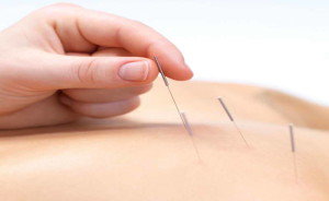 One session acupuncture - £35 / 30 mins