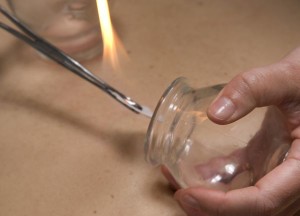 chinese cupping-swisscottage massage